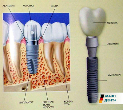 Полная имплантация зубов верхней челюсти
